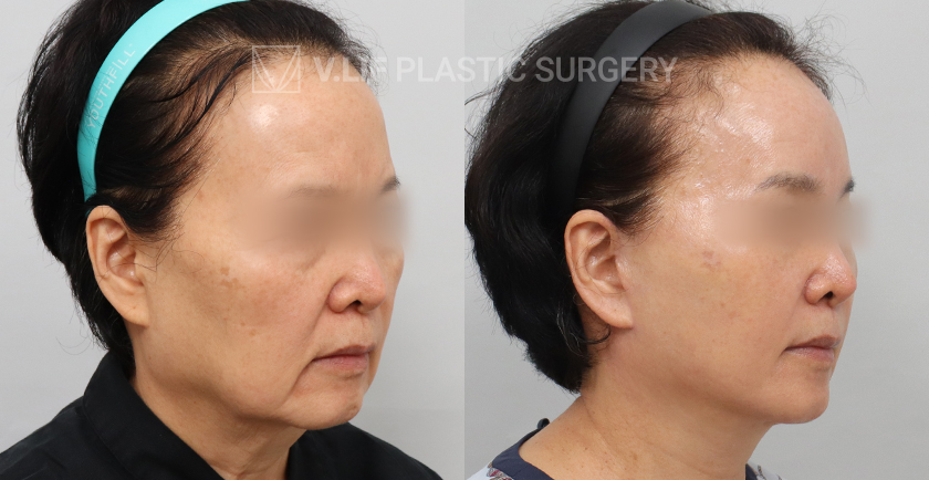 Facelift before and after — Vlif Plastic surgery