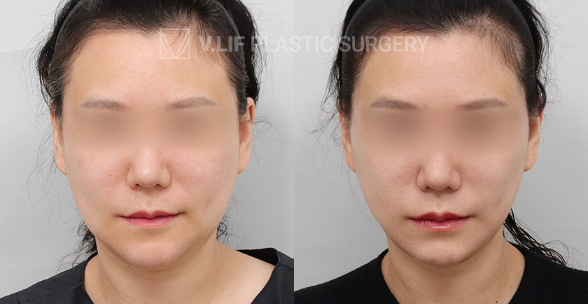 Facelift before and after — Vlif Plastic surgery