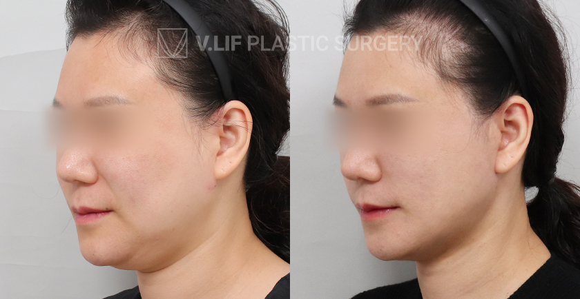 Facelift before and after — Vlif Plastic surgery