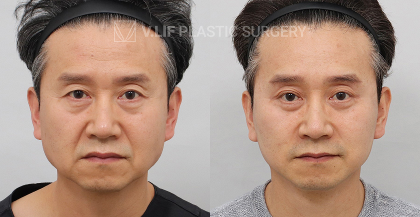 Facelift before and after — Vlif Plastic surgery