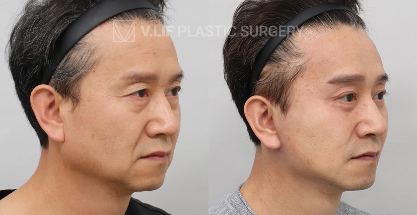 Facelift before and after — Vlif Plastic surgery