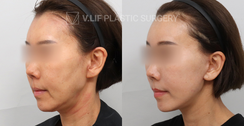 Facelift before and after — Vlif Plastic surgery