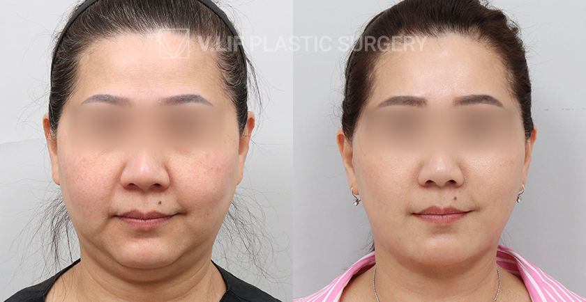 Facelift before and after — Vlif Plastic surgery