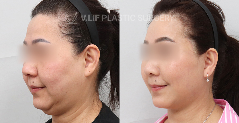 Facelift before and after — Vlif Plastic surgery