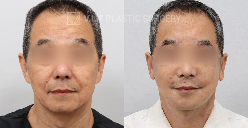 Facelift before and after — Vlif Plastic surgery