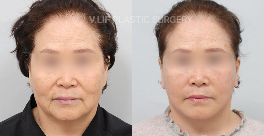 Facelift before and after — Vlif Plastic surgery