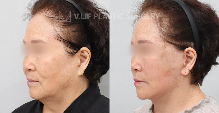 Facelift before and after — Vlif Plastic surgery
