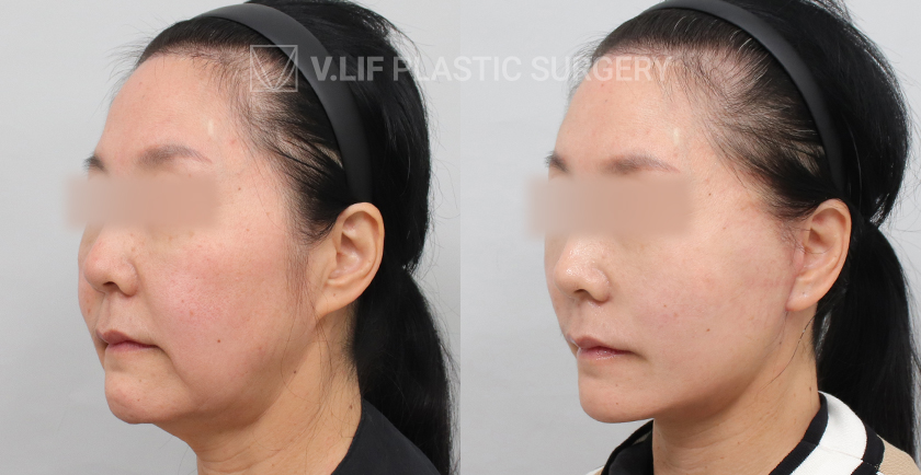 Mini Lift before and after — Vlif Plastic surgery