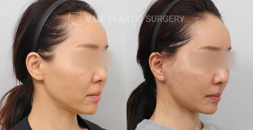 Mini Lift before and after — Vlif Plastic surgery