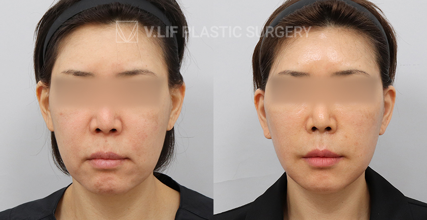 Mini Lift before and after — Vlif Plastic surgery