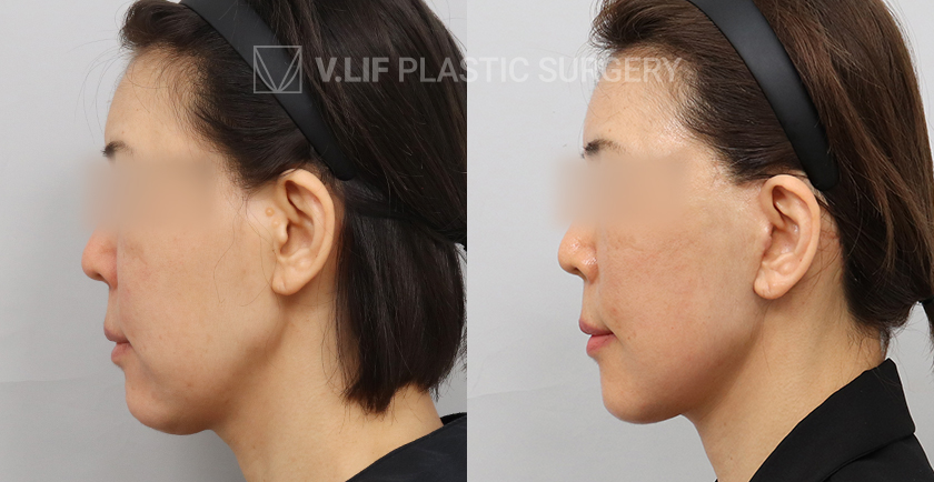 Mini Lift before and after — Vlif Plastic surgery