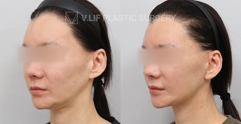 Mini Lift before and after — Vlif Plastic surgery