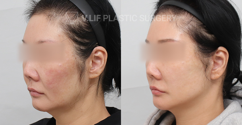 Mini Lift before and after — Vlif Plastic surgery
