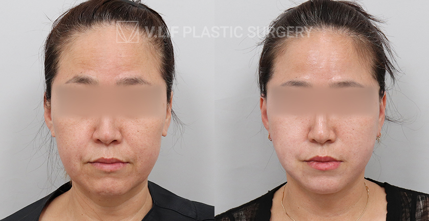 Mini Lift before and after — Vlif Plastic surgery