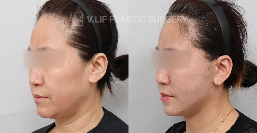 Mini Lift before and after — Vlif Plastic surgery