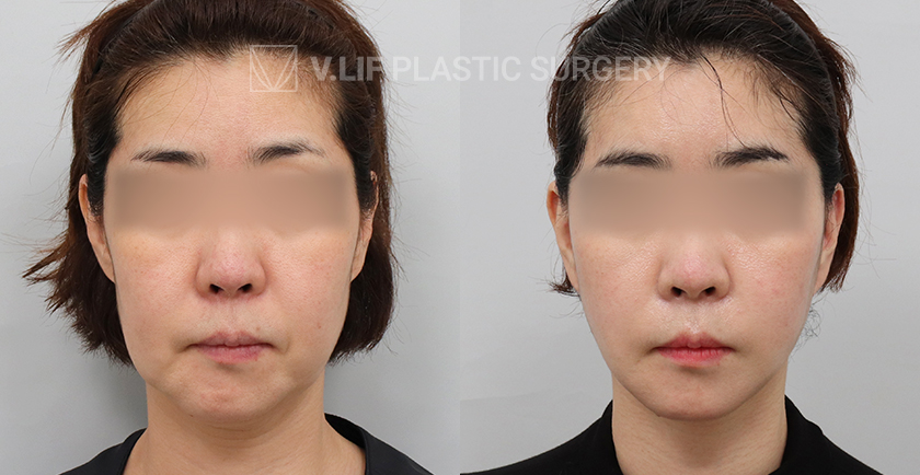 Mini Lift before and after — Vlif Plastic surgery