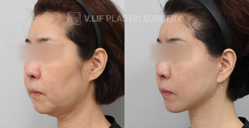 Mini Lift before and after — Vlif Plastic surgery