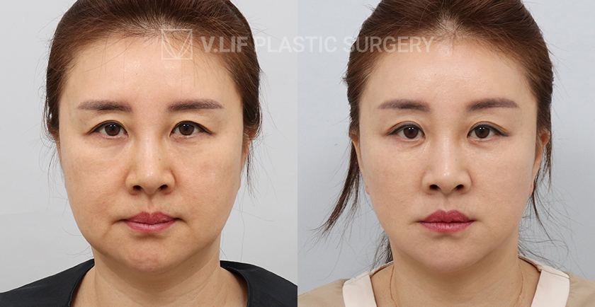 Mini Lift before and after — Vlif Plastic surgery