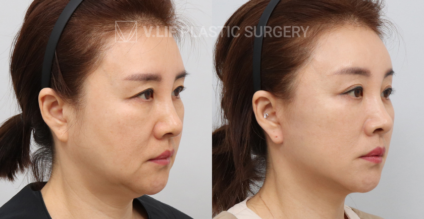 Mini Lift before and after — Vlif Plastic surgery