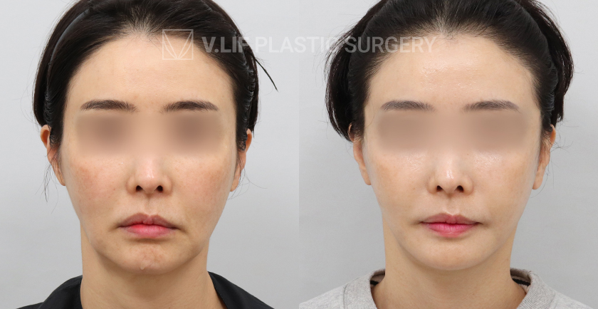 Mini Lift before and after — Vlif Plastic surgery