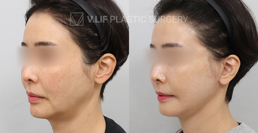 Mini Lift before and after — Vlif Plastic surgery