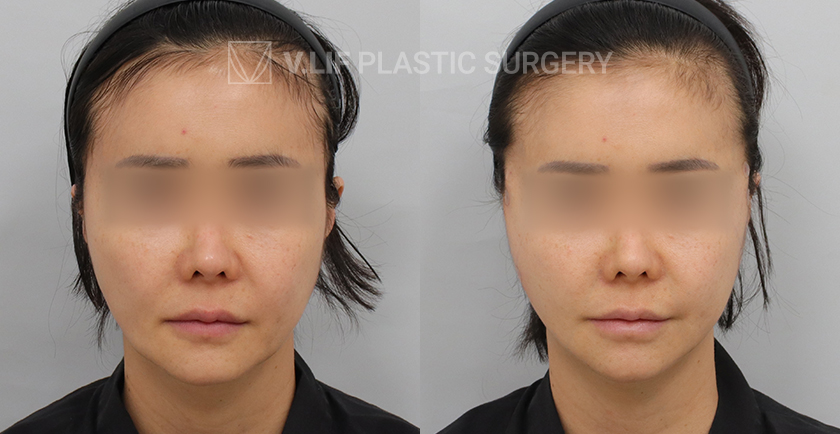Thread Lift before and after — Vlif Plastic surgery