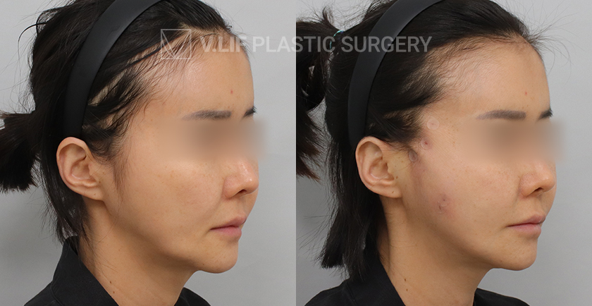 Thread Lift before and after — Vlif Plastic surgery