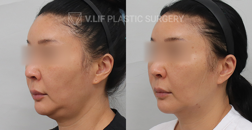 Thread Lift before and after — Vlif Plastic surgery