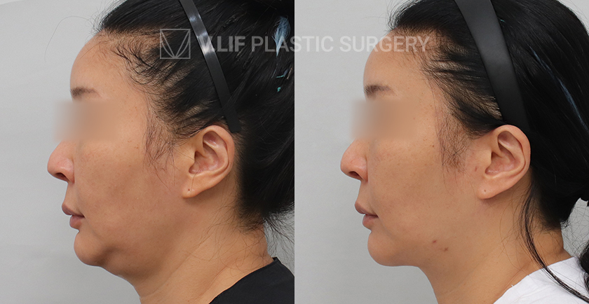 Thread Lift before and after — Vlif Plastic surgery