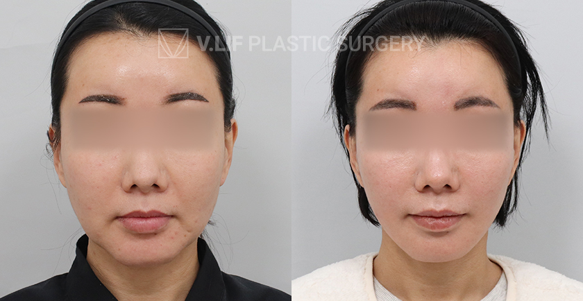 Mini Lift before and after — Vlif Plastic surgery