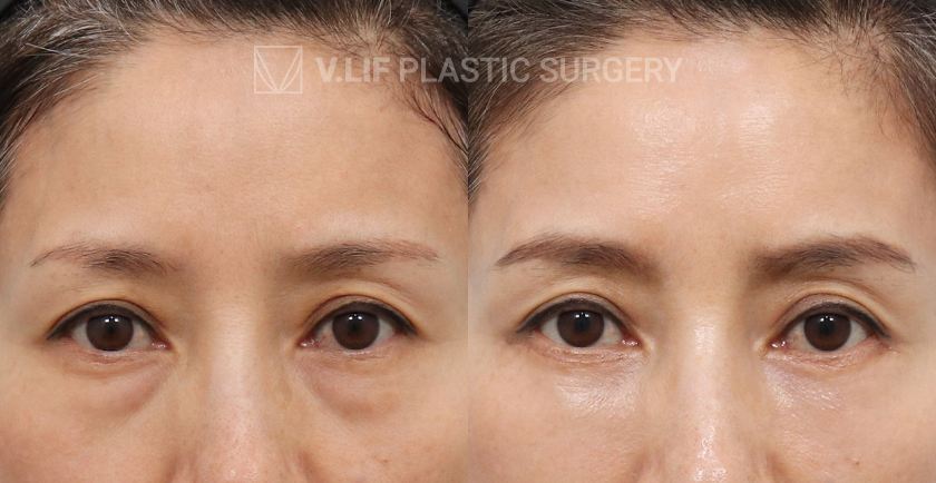 Lower Blepharoplasty before and after — Vlif Plastic surgery