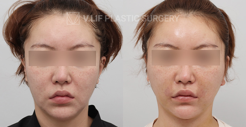 Mini Lift (Low) before and after — Vlif Plastic surgery