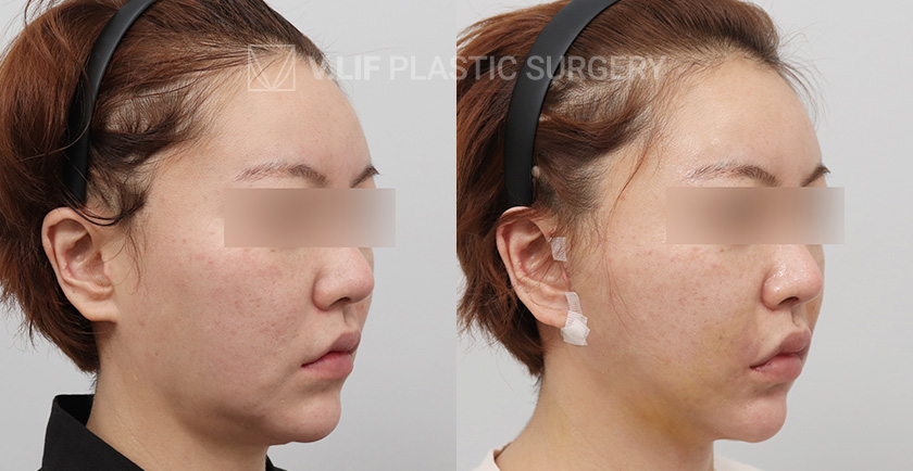 Mini Lift (Low) before and after — Vlif Plastic surgery