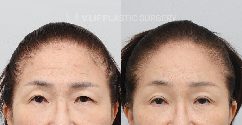Endoscopic Forehead Lift Face Neck Lift Lower Blepharoplasty before and after — Vlif Plastic surgery