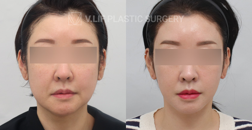 Face Neck Lift before and after — Vlif Plastic surgery