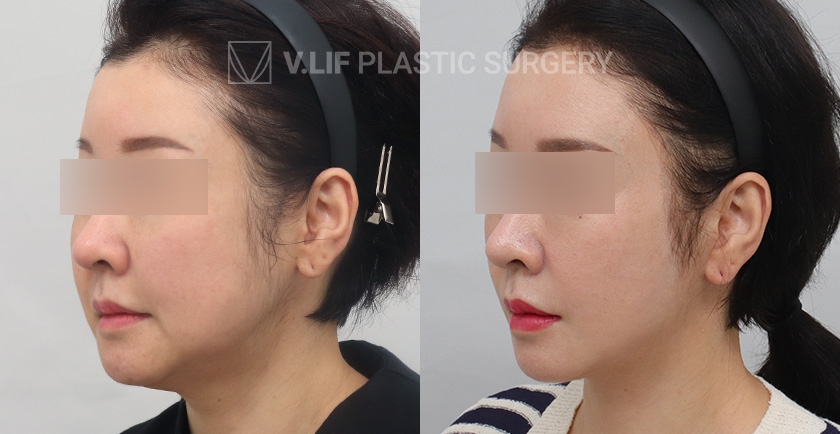 Face Neck Lift before and after — Vlif Plastic surgery