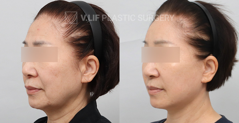 Face Neck Lift Endoscopic Forehead Lift Lower Blepharoplasty before and after — Vlif Plastic surgery
