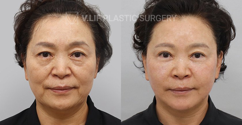 Face Neck Lift Sub Brow Lift Lower Blepharoplasty before and after — Vlif Plastic surgery