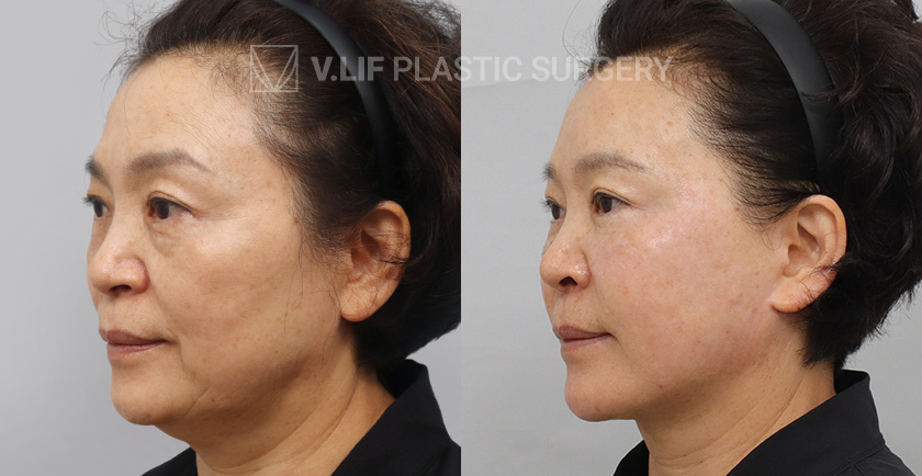 Face Neck Lift Sub Brow Lift Lower Blepharoplasty before and after — Vlif Plastic surgery