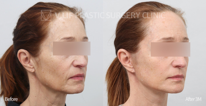 Face Neck Lift Platysma Plication before and after — Vlif Plastic surgery