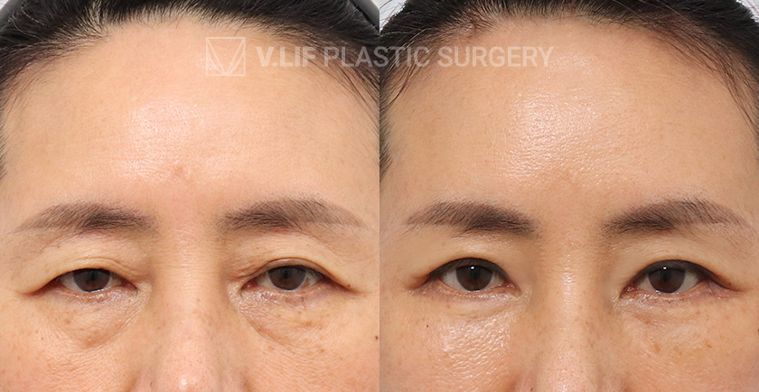 Endoscopic Forehead Lift Upper Blepharoplasty Lower Blepharo before and after — Vlif Plastic surgery