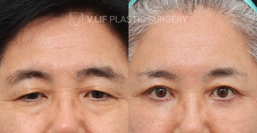 Upper Blepharoplasty Lower Blepharoplasty before and after — Vlif Plastic surgery