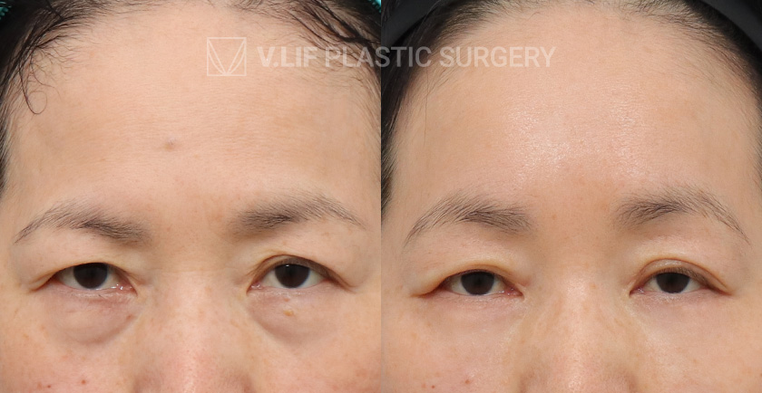 Endoscopic Forehead Lift Lower Blepharoplasty before and after — Vlif Plastic surgery