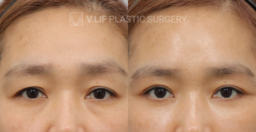 Sub Brow Lift Lower Blepharoplasty before and after — Vlif Plastic surgery
