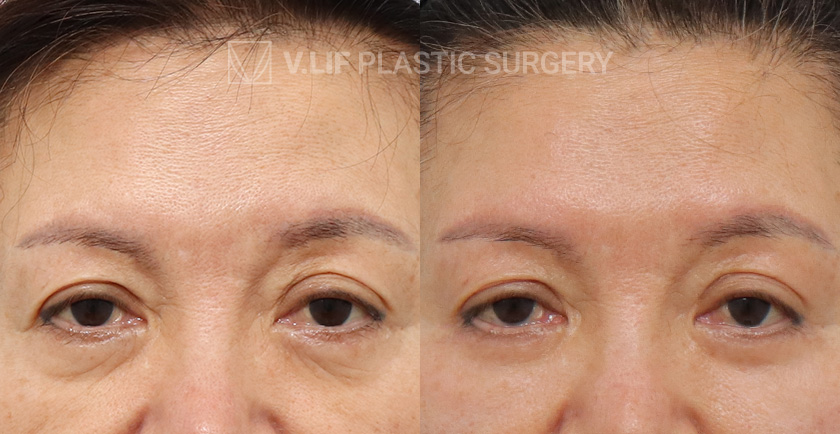 Revision Lower Blepharoplasty before and after — Vlif Plastic surgery