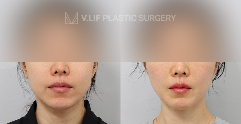Thread Lift Quick Lift before and after — Vlif Plastic surgery
