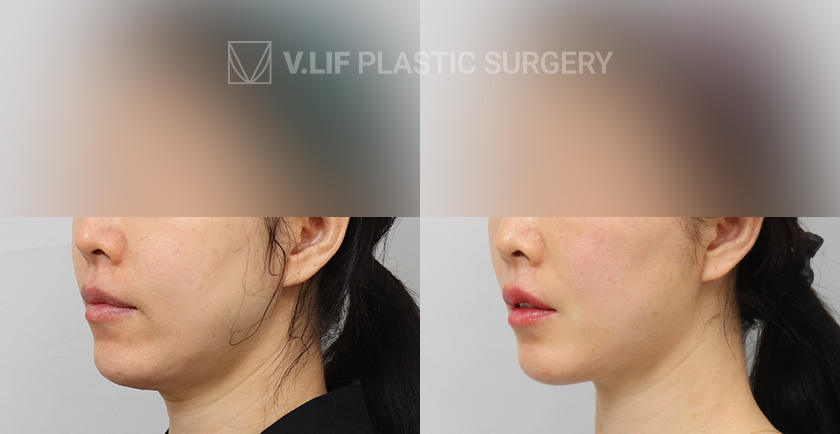 Thread Lift Quick Lift before and after — Vlif Plastic surgery