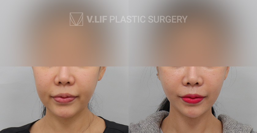 Thread Lift before and after — Vlif Plastic surgery