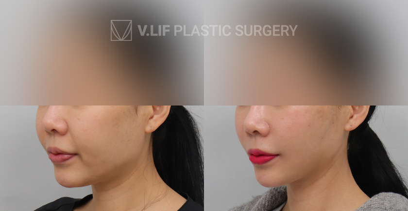 Thread Lift before and after — Vlif Plastic surgery