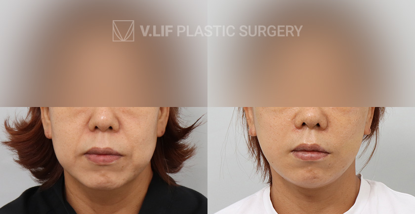 Thread Lift before and after — Vlif Plastic surgery